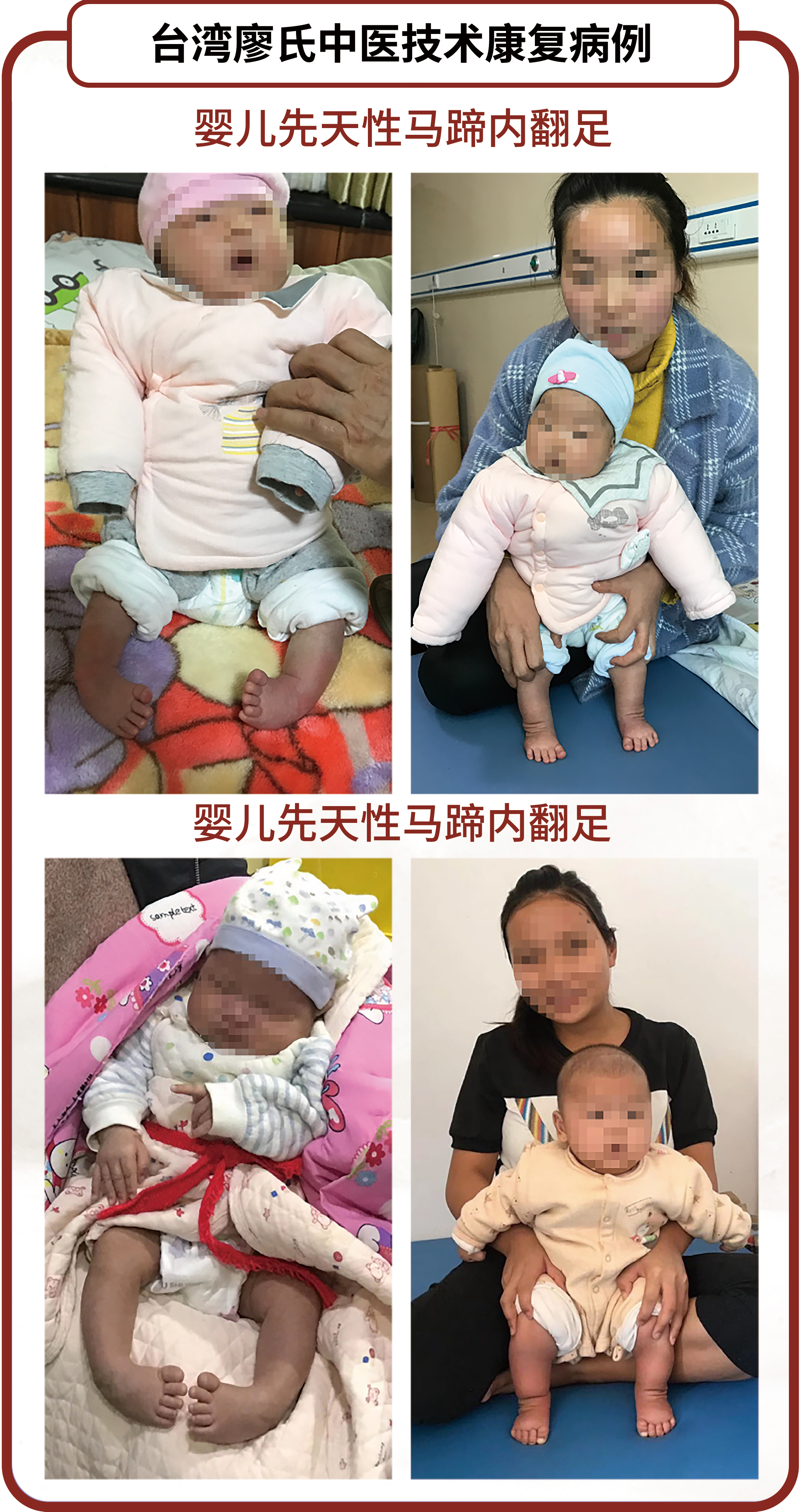 长城医院婴儿马蹄内翻足矫正