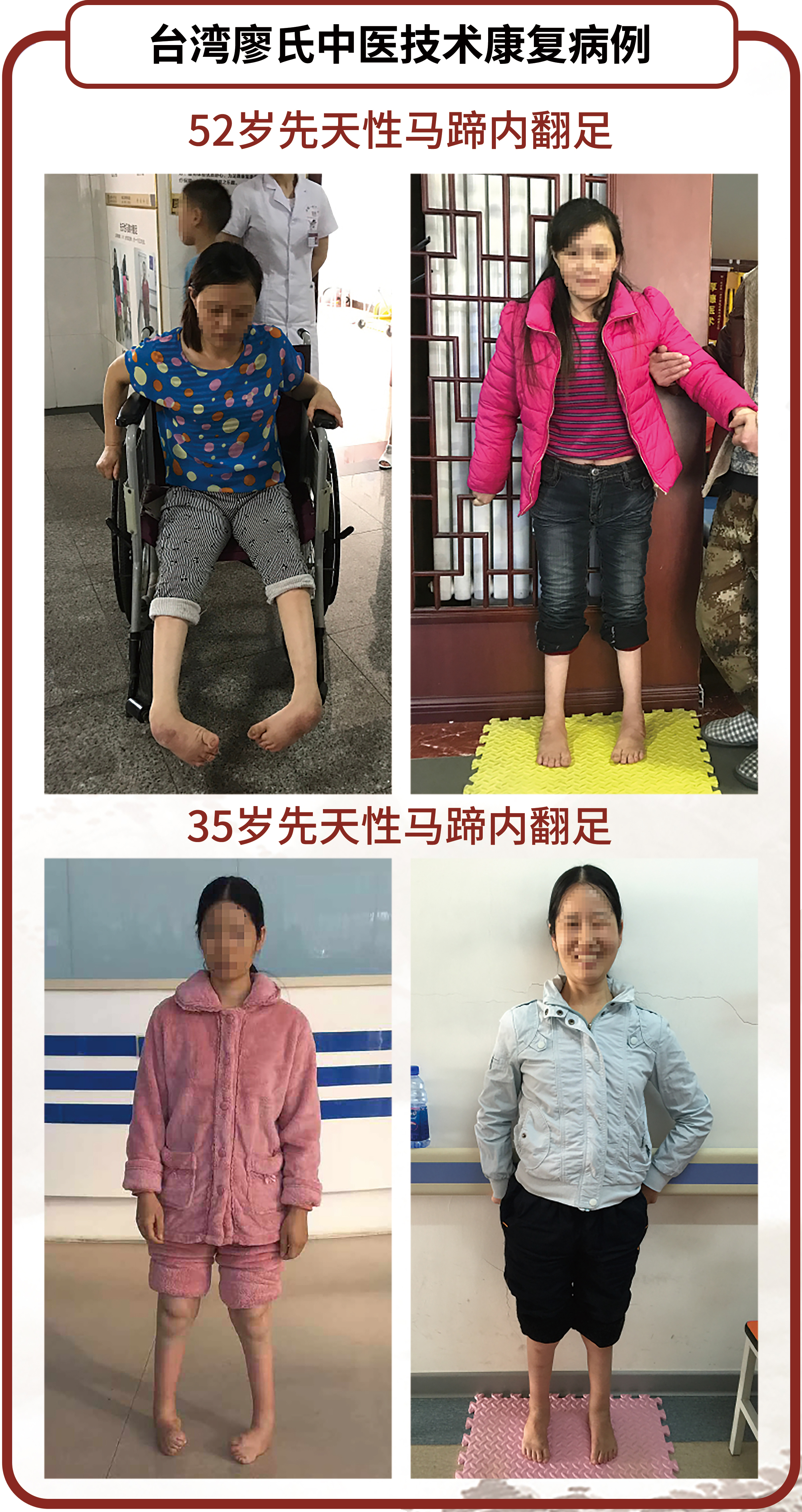 长城医院先天性马蹄内翻足矫正